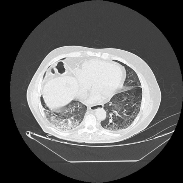 Cavitating bronchogenic carcinoma (Radiopaedia 44489-48162 Axial lung window 60).jpg