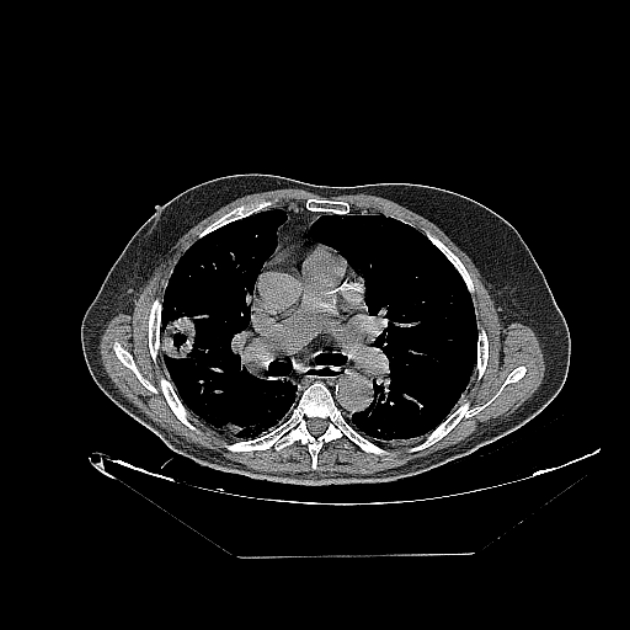 Cavitating bronchogenic carcinoma (Radiopaedia 44489-48162 Axial non-contrast 38).jpg