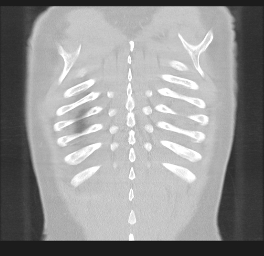 Cavitating pneumonia complicated by pneumothorax (Radiopaedia 48149-52994 Coronal lung window 52).png