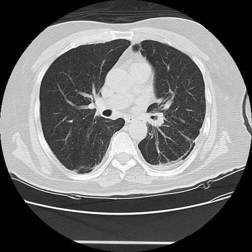 Cavitating pulmonary metastases (Radiopaedia 89545-106544 Axial lung window 28).jpg