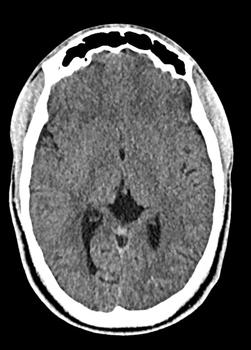 Cavum septum pellucidum and cavum vergae (Radiopaedia 77797-90060 Axial Brain Window 51).jpg