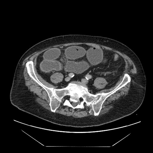 Cecal adenocarcinoma (Radiopaedia 64871-73817 A 69).jpg