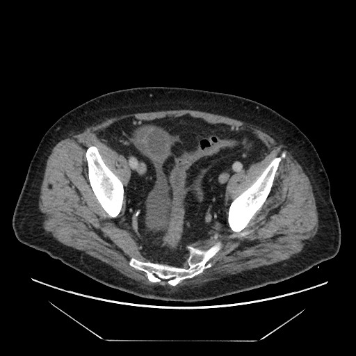 Cecal adenocarcinoma (Radiopaedia 64871-73817 A 81).jpg