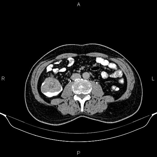 Cecal adenocarcinoma (Radiopaedia 85324-100916 Axial C+ delayed 52).jpg