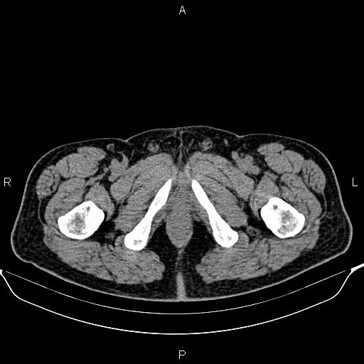 Cecal adenocarcinoma (Radiopaedia 85324-100916 Axial non-contrast 107).jpg