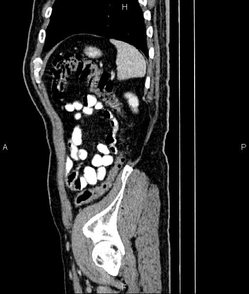 File:Cecal cancer with appendiceal mucocele (Radiopaedia 91080-108651 E 81).jpg