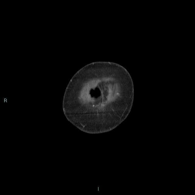 Cecal volvulus (Radiopaedia 71372-81698 C 4).jpg