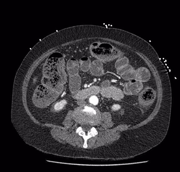 Celiac artery severe stenosis and dissection (Radiopaedia 44128-47842 B 50).jpg