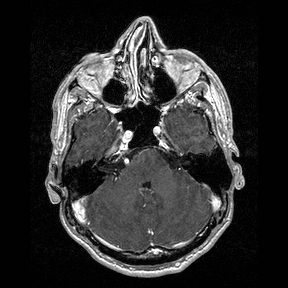 File:Central-variant posterior reversible encephalopathy syndrome (PRES) (Radiopaedia 43880-47358 Axial T1 C+ 35).jpg