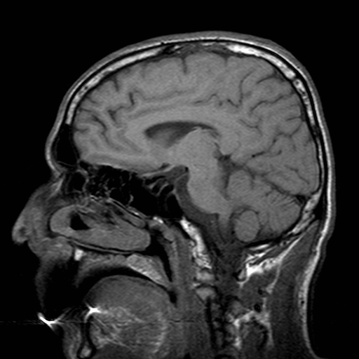 File:Central-variant posterior reversible encephalopathy syndrome (PRES) (Radiopaedia 43880-47359 Sagittal T1 10).jpg