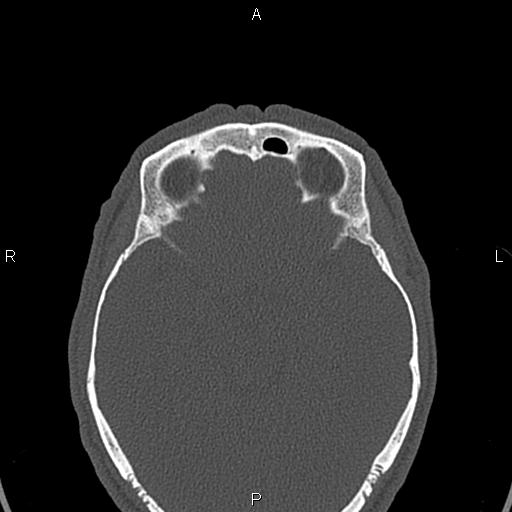 Central giant cell granuloma (Radiopaedia 83346-97761 Axial bone window 70).jpg