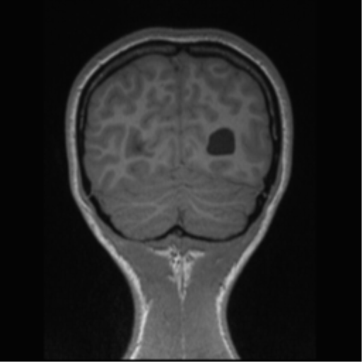 Central neurocytoma (Radiopaedia 37664-39557 Coronal T1 18).png