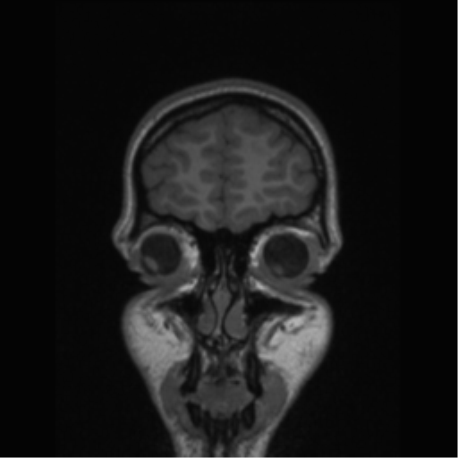 Central neurocytoma (Radiopaedia 37664-39557 Coronal T1 80).png