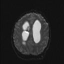 Central neurocytoma (Radiopaedia 56690-63469 Axial DWI 15).jpg