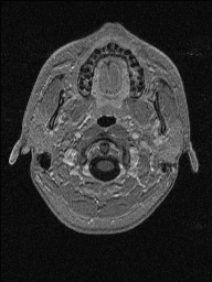 Central neurocytoma (Radiopaedia 56690-63469 Axial T1 C+ 11).jpg