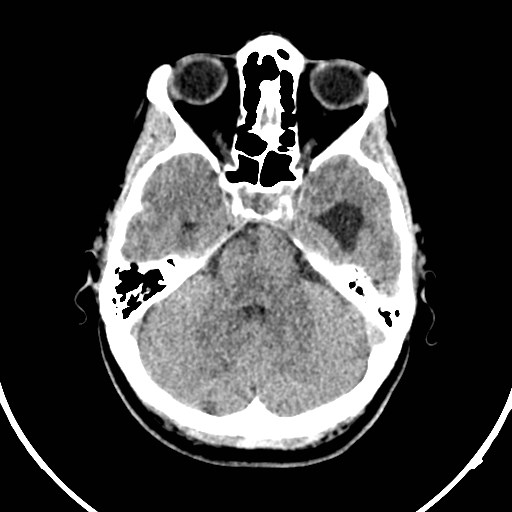 Central neurocytoma (Radiopaedia 84497-99871 Axial non-contrast 12).jpg