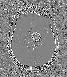 File:Central neurocytoma (Radiopaedia 84497-99872 Axial 39).jpg