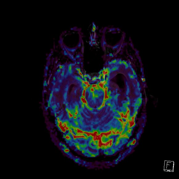 Central neurocytoma (Radiopaedia 84497-99872 Axial Perfusion 218).jpg