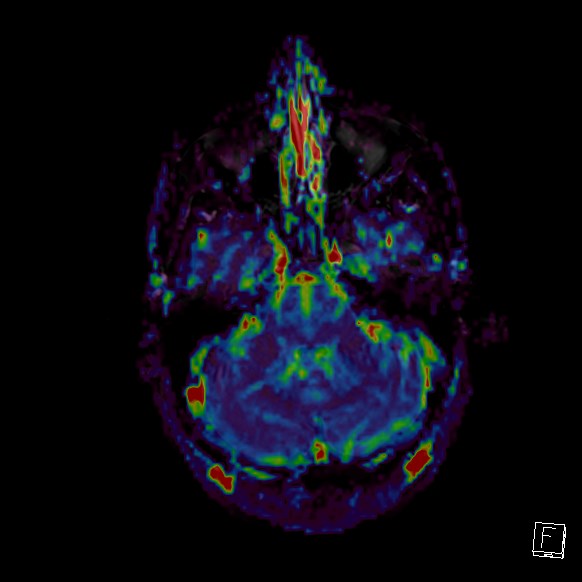 Central neurocytoma (Radiopaedia 84497-99872 Axial Perfusion 252).jpg