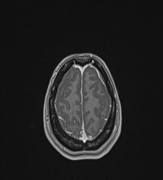 File:Central neurocytoma (Radiopaedia 84497-99872 Axial T1 C+ 134).jpg