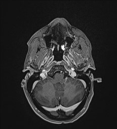 File:Central neurocytoma (Radiopaedia 84497-99872 Axial T1 C+ 30).jpg