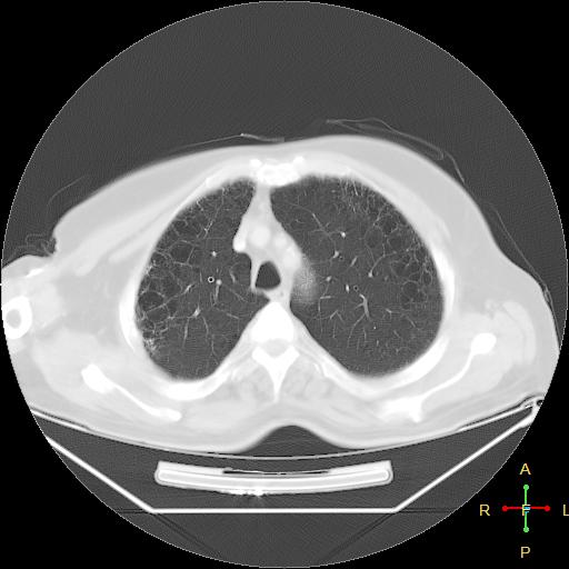 File:Centrilobular emphysema - with superimposed infection (Radiopaedia 24389-24683 lung window 7).jpg