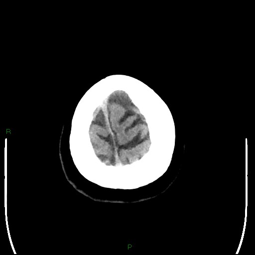 Cerebellar abscess (Radiopaedia 78135-90671 Axial non-contrast 105).jpg