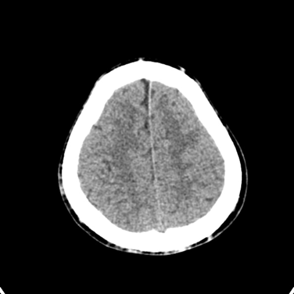 Cerebellar abscess secondary to mastoiditis (Radiopaedia 26284-26412 Axial non-contrast 133).jpg