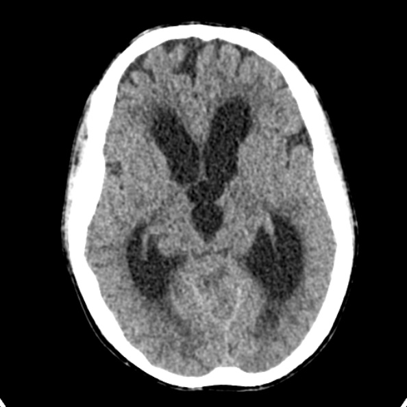 Cerebellar abscess secondary to mastoiditis (Radiopaedia 26284-26412 Axial non-contrast 72).jpg