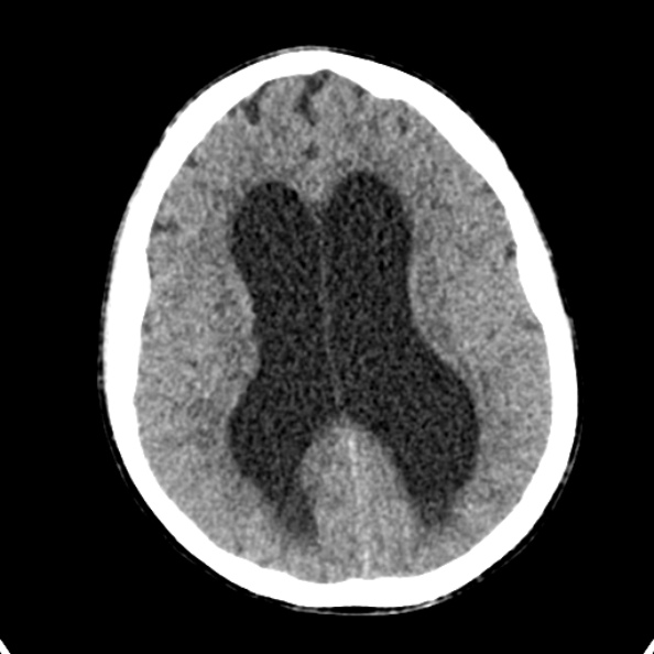 File:Cerebellar abscess secondary to mastoiditis (Radiopaedia 26284-26412 Axial non-contrast 95).jpg