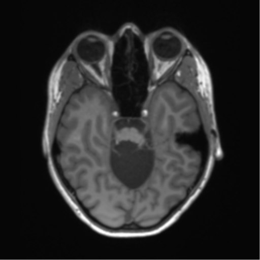 File:Cerebellar agenesis with hypoplastic pons (pontocerebellar hypoplasia) (Radiopaedia 57224-64138 Axial T1 27).png