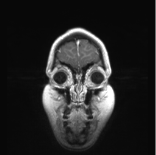Cerebellar ependymoma complicated by post-operative subdural hematoma (Radiopaedia 83322-97736 Coronal T1 C+ 5).png