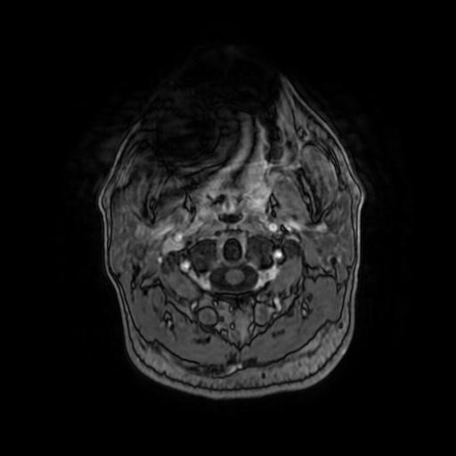 Cerebellar hemangioblastoma (Radiopaedia 88055-104622 Axial T1 C+ 8).jpg