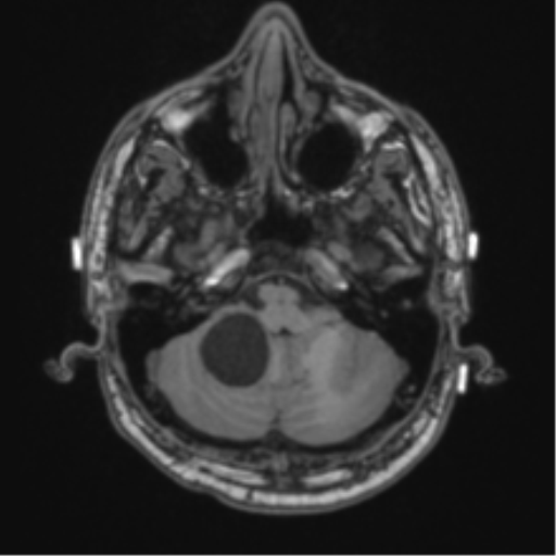 Cerebellar hemangioblastomas and pituitary adenoma (Radiopaedia 85490-101176 Axial T1 16).png