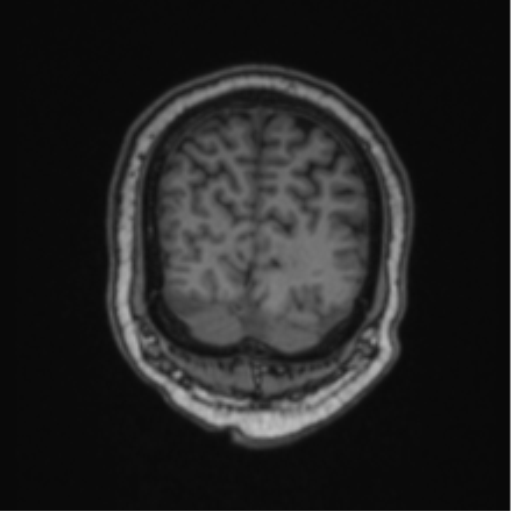 Cerebellar hemangioblastomas and pituitary adenoma (Radiopaedia 85490-101176 Coronal T1 19).png