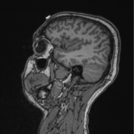 Cerebellar hemangioblastomas and pituitary adenoma (Radiopaedia 85490-101176 Sagittal T1 71).png