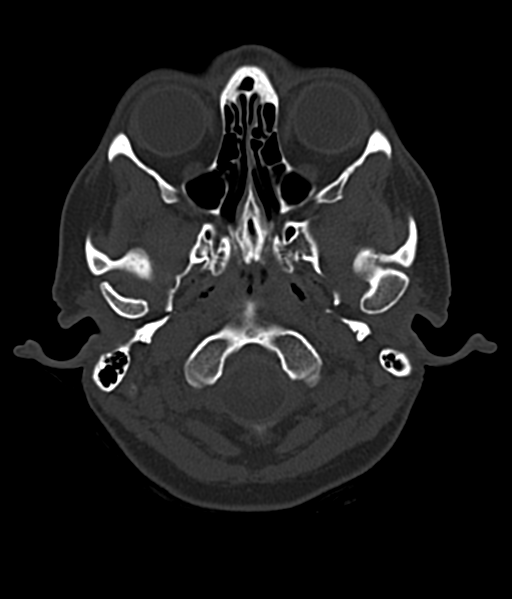Cerebellar metastases - colorectal adenocarcinoma (Radiopaedia 40947-43652 AX Bone C- 2.0 MPR 4).png