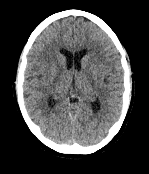 Cerebellar metastases - colorectal adenocarcinoma (Radiopaedia 40947-43652 Axial non-contrast 33).png