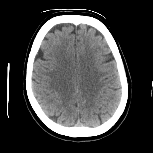 Cerebellar metastasis (cystic appearance) (Radiopaedia 41395-44258 Axial non-contrast 37).png