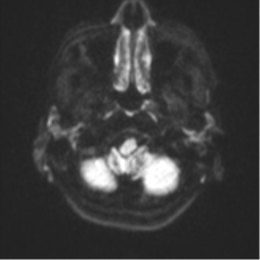 Cerebellar metastasis - adenocarcinoma lung (Radiopaedia 63184-71715 Axial DWI 31).png