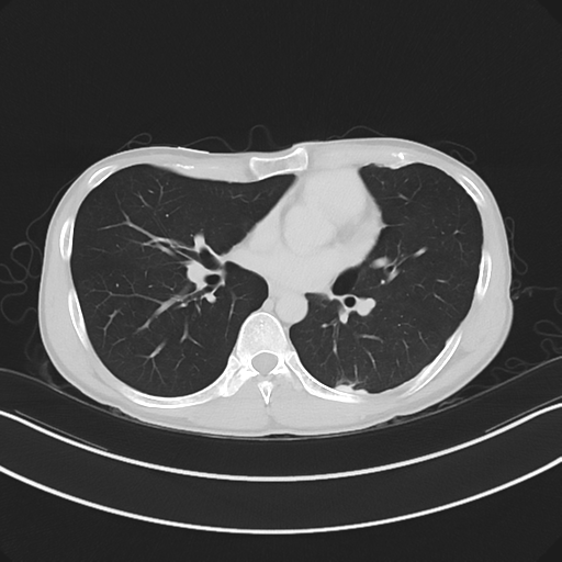 Cerebellar metastasis - adenocarcinoma lung (Radiopaedia 63184-71717 Axial lung window 38).png