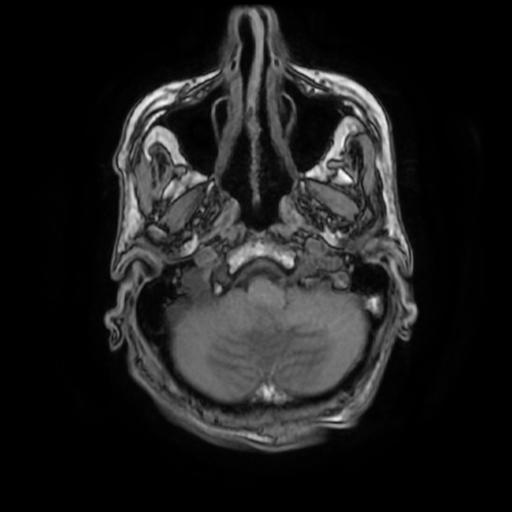File:Cerebellar metastasis - lung tumor (Radiopaedia 69317-79147 Axial T1 8).jpg