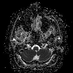File:Cerebellar metastasis of pulmonary adenocarcinoma, cavernous venous malformation, and developmental venous anomaly (Radiopaedia 85827-101661 Axial ADC 6).jpg