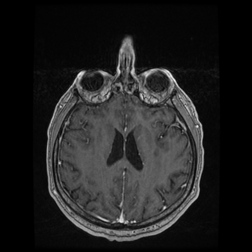 Cerebellar metastasis of pulmonary adenocarcinoma, cavernous venous malformation, and developmental venous anomaly (Radiopaedia 85827-101661 Axial T1 C+ 61).jpg