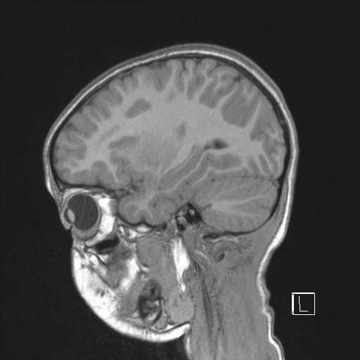 Cerebellar stroke (Radiopaedia 32202-33150 Sagittal T1 C+ 37).png