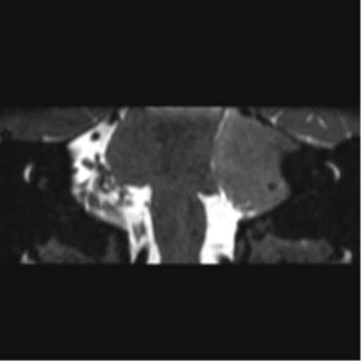 Cerebellopontine angle meningioma (Radiopaedia 48434-53348 Coronal T2 41).png