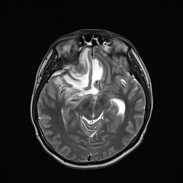 Cerebral abscess (Radiopaedia 24212-24478 Axial T2 28).jpg
