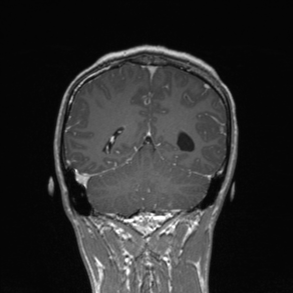 Cerebral abscess (Radiopaedia 24212-24478 Coronal T1 C+ 149).jpg