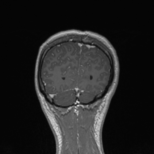 Cerebral abscess (Radiopaedia 24212-24478 Coronal T1 C+ 172).jpg