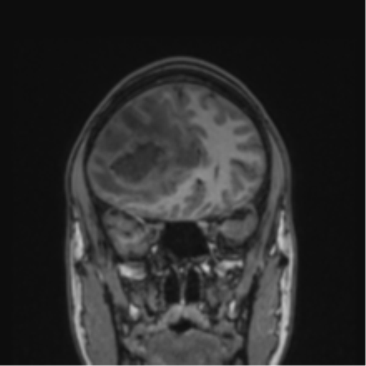 Cerebral abscess (Radiopaedia 60342-68009 Coronal T1 38).png
